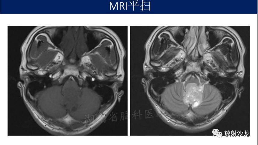 【病例】四脑室室管膜瘤1例MR影像表现