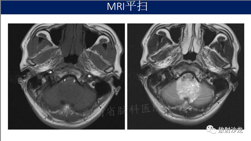 【病例】四脑室室管膜瘤1例MR影像表现
