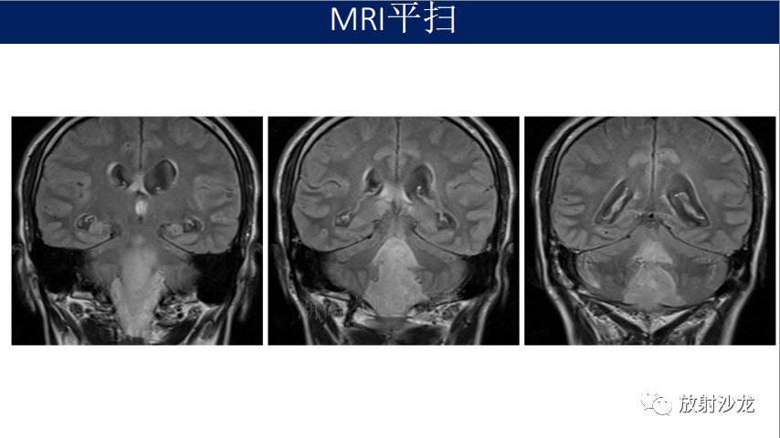 【病例】四脑室室管膜瘤1例MR影像表现