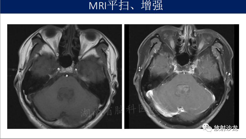 【病例】四脑室室管膜瘤1例MR影像表现