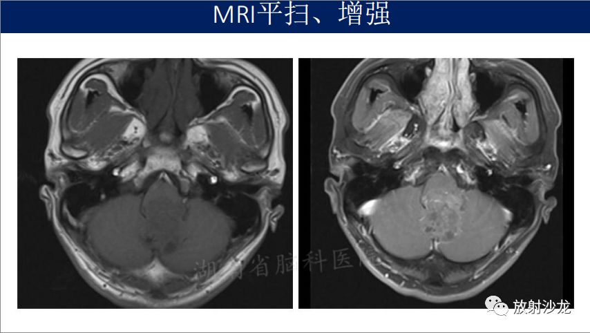 【病例】四脑室室管膜瘤1例MR影像表现