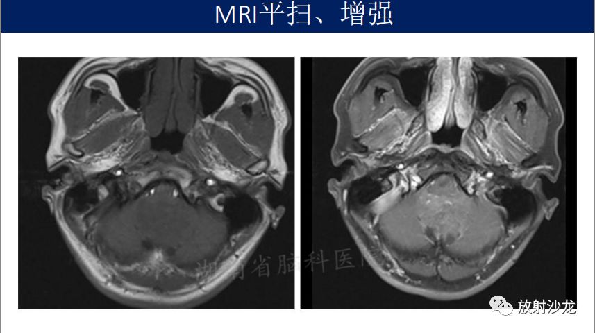 【病例】四脑室室管膜瘤1例MR影像表现