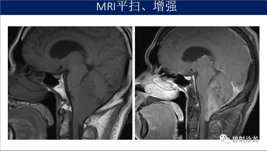 【病例】四脑室室管膜瘤1例MR影像表现