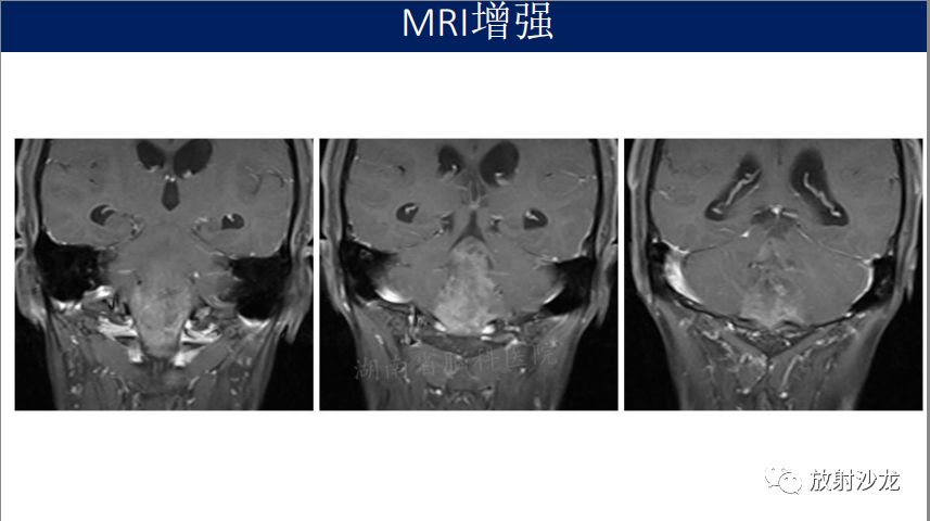 【病例】四脑室室管膜瘤1例MR影像表现