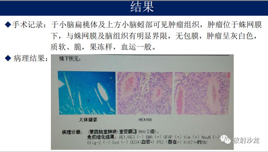 【病例】四脑室室管膜瘤1例MR影像表现