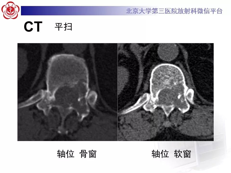 【病例】脊柱骨母细胞瘤1例CT及MR