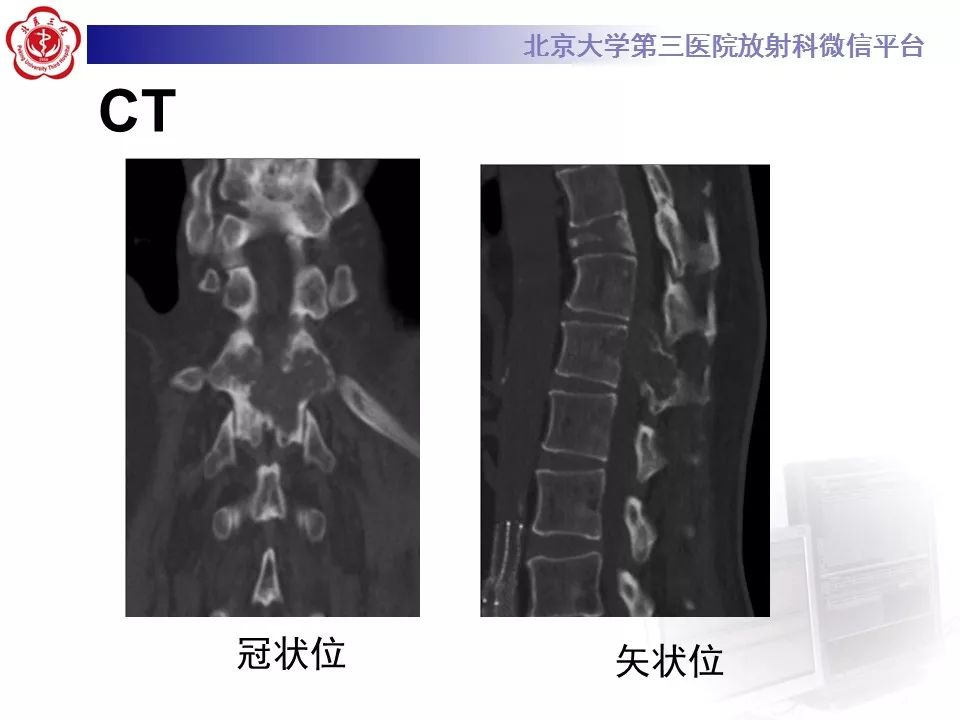 【病例】脊柱骨母细胞瘤1例CT及MR