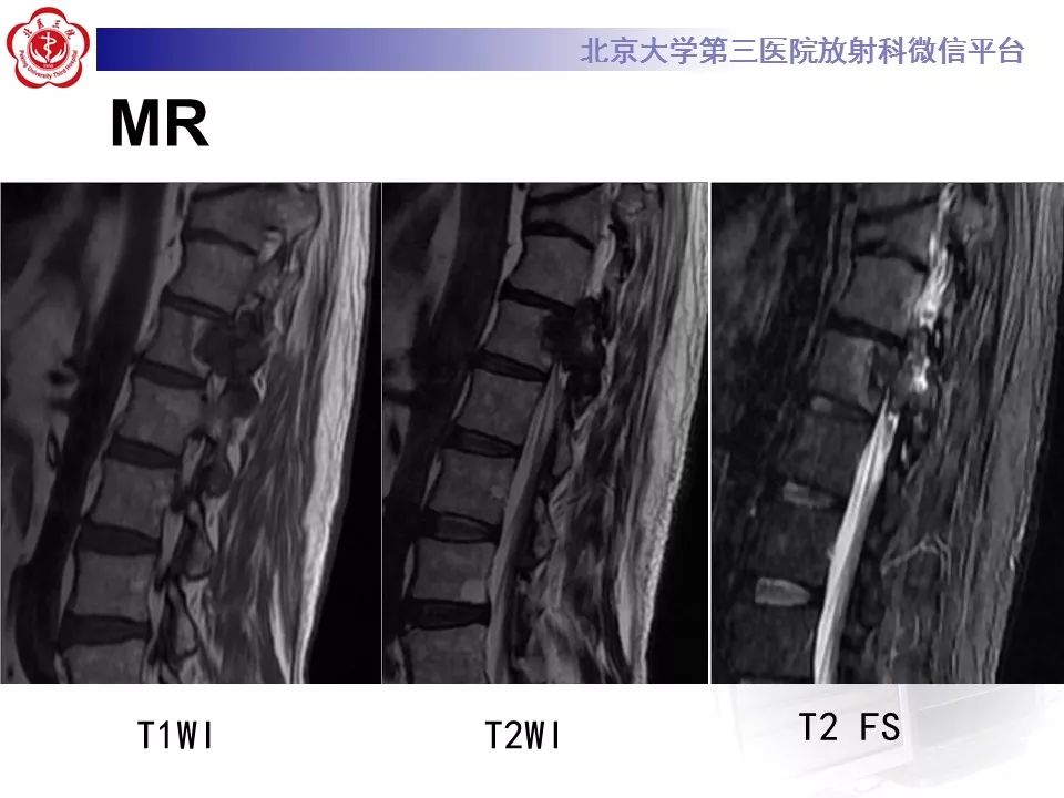 【病例】脊柱骨母细胞瘤1例CT及MR