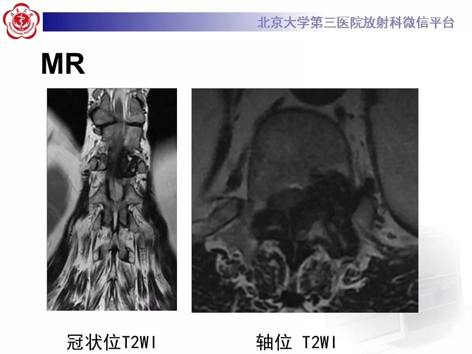 【病例】脊柱骨母细胞瘤1例CT及MR