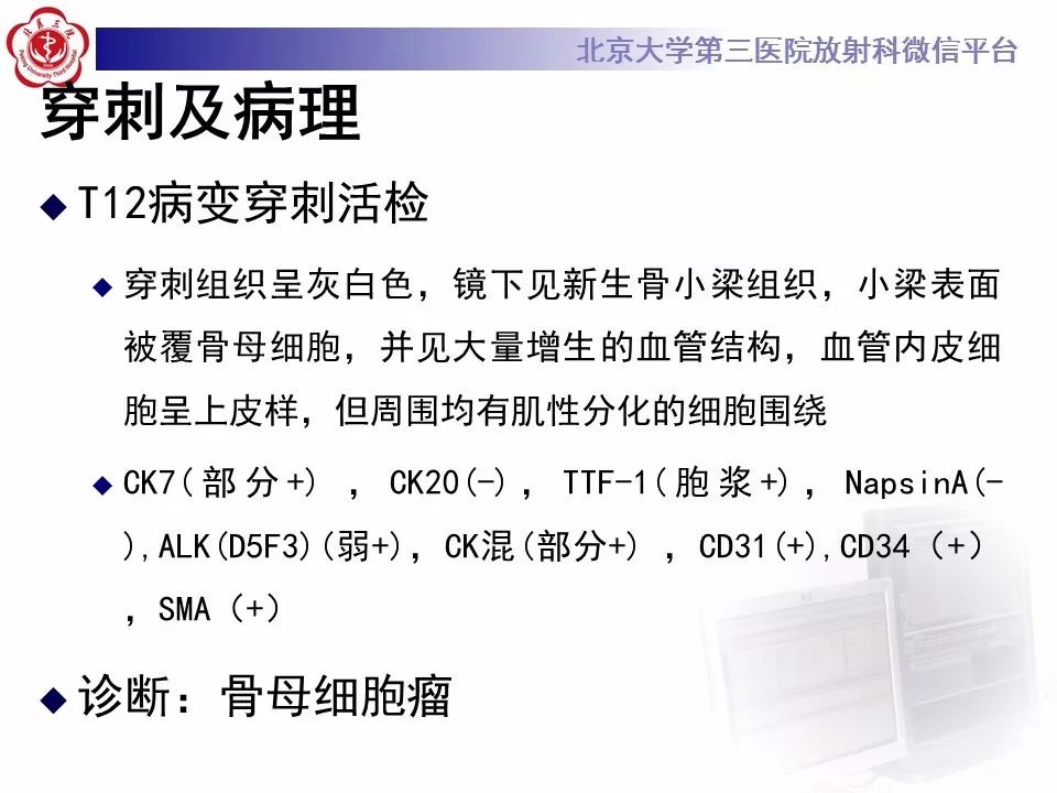 【病例】脊柱骨母细胞瘤1例CT及MR