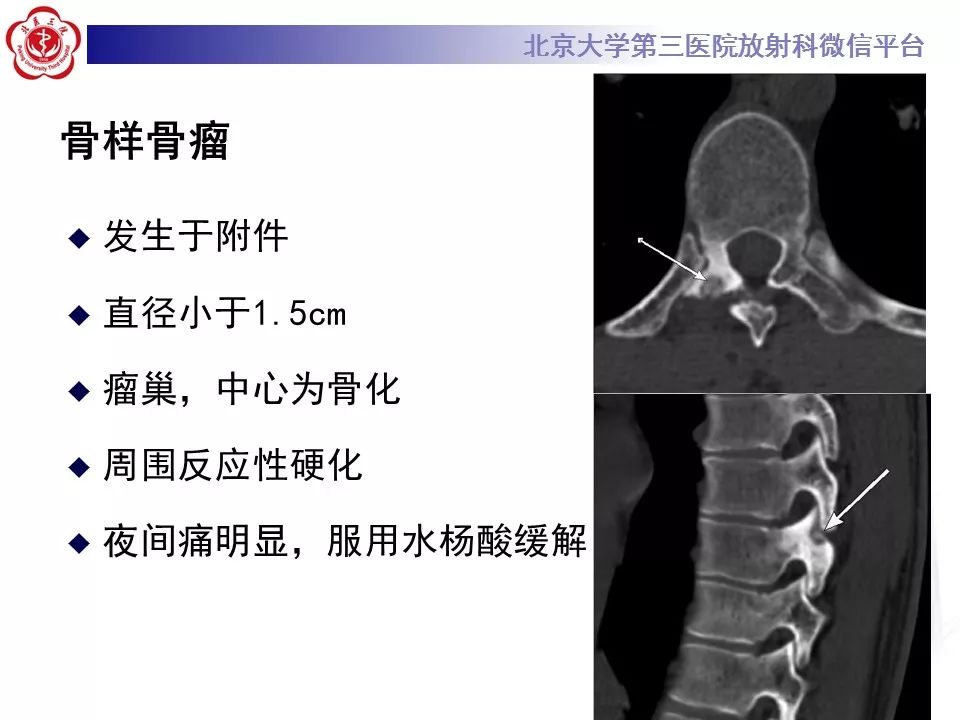 【病例】脊柱骨母细胞瘤1例CT及MR