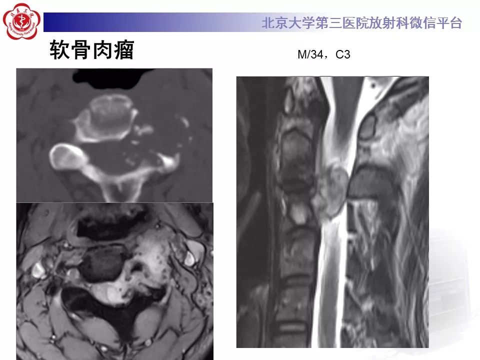 【病例】脊柱骨母细胞瘤1例CT及MR