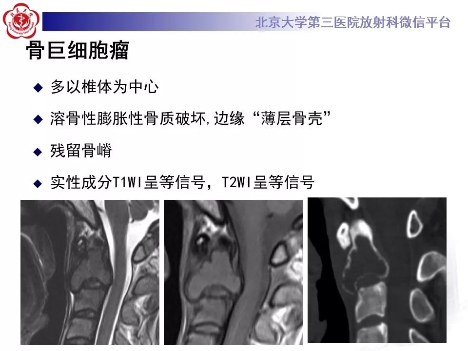 【病例】脊柱骨母细胞瘤1例CT及MR