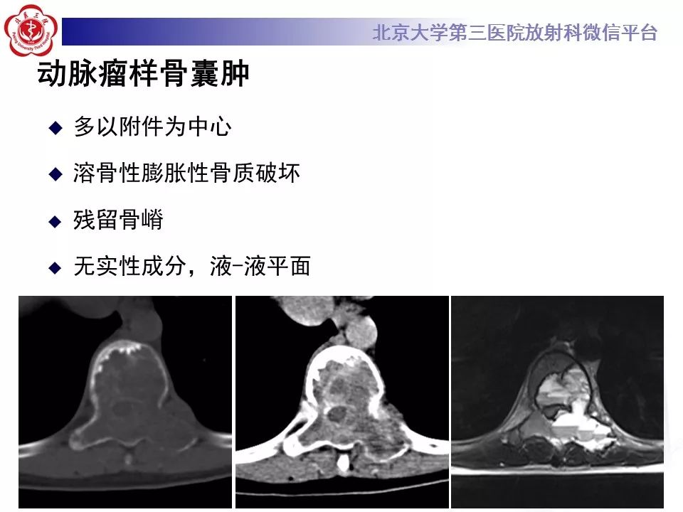 【病例】脊柱骨母细胞瘤1例CT及MR