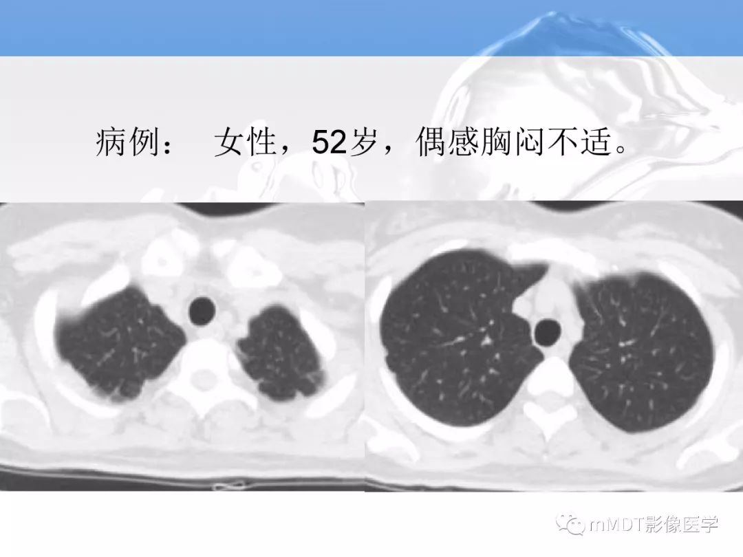 【病例】肺孤立性体循环动脉供血