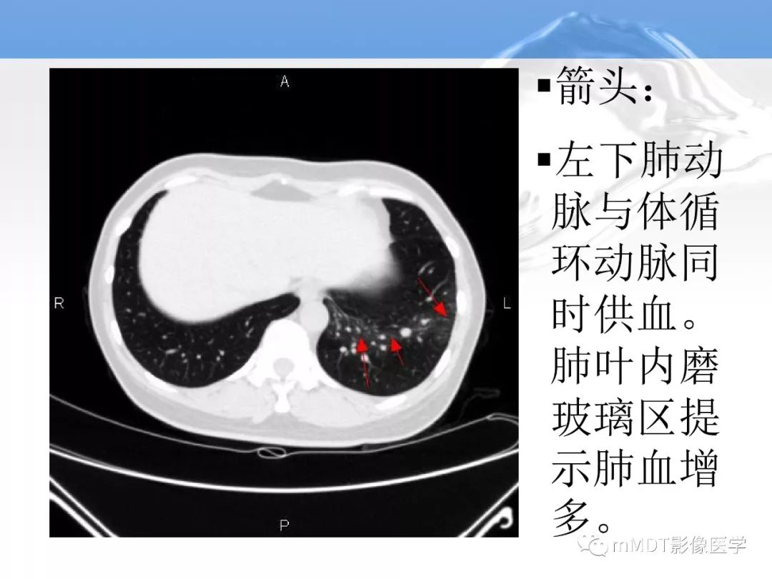 【病例】肺孤立性体循环动脉供血