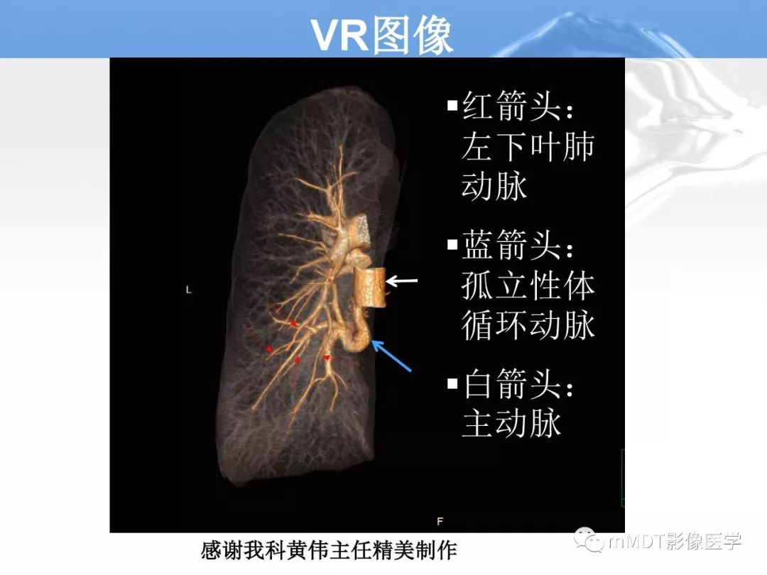 【病例】肺孤立性体循环动脉供血