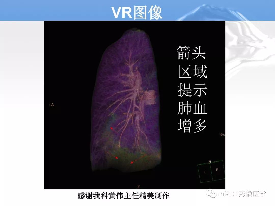 【病例】肺孤立性体循环动脉供血