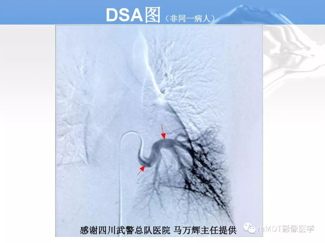【病例】肺孤立性体循环动脉供血