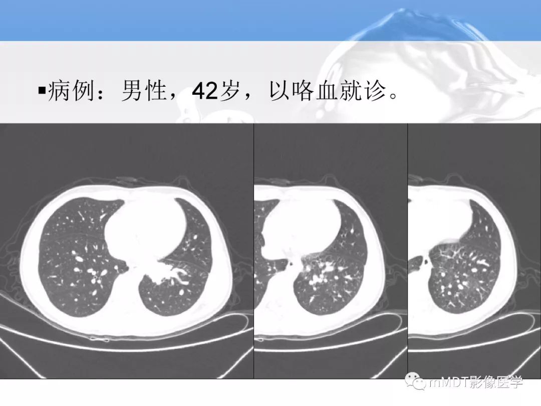 【病例】肺孤立性体循环动脉供血