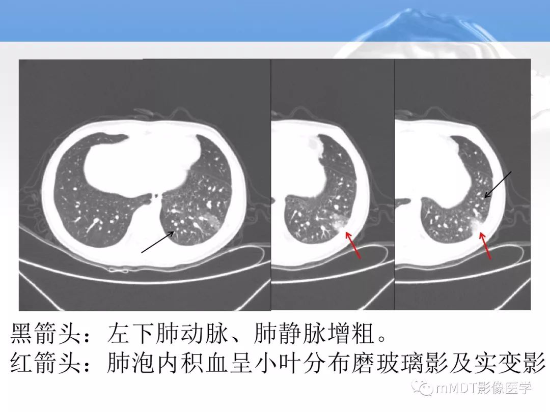 【病例】肺孤立性体循环动脉供血