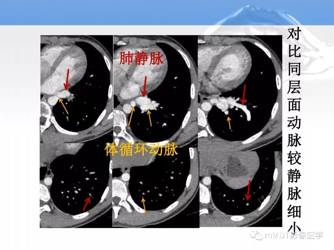【病例】肺孤立性体循环动脉供血
