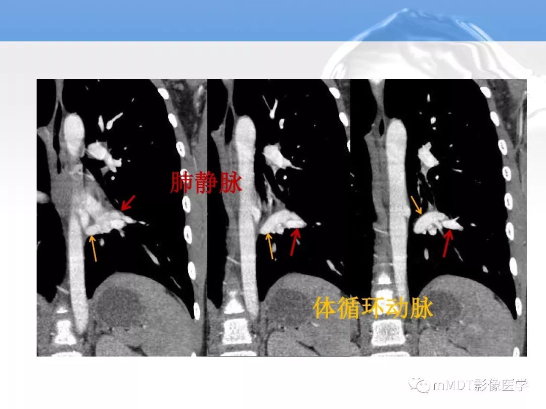 【病例】肺孤立性体循环动脉供血