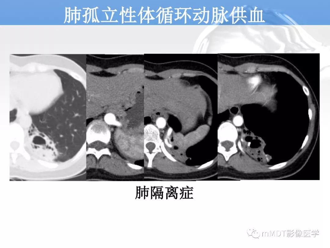【病例】肺孤立性体循环动脉供血