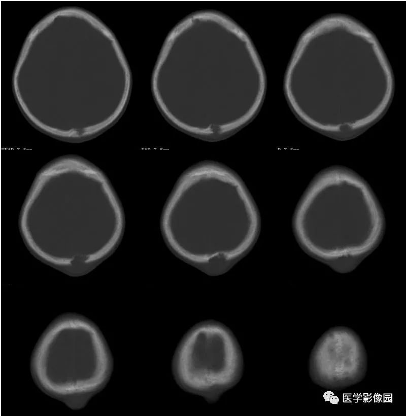 【病例】颅骨嗜酸性肉芽肿1例CT影像表现 【病例】颅骨嗜酸性肉芽肿1例CT影像表现