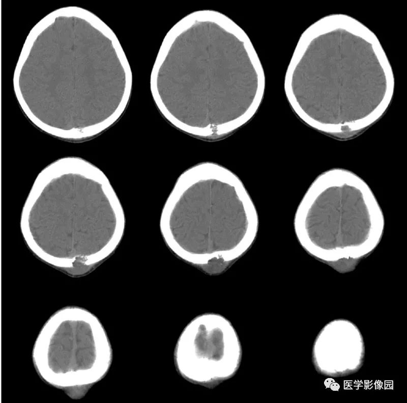 【病例】颅骨嗜酸性肉芽肿1例CT影像表现 【病例】颅骨嗜酸性肉芽肿1例CT影像表现