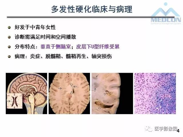 【PPT】MR在MS诊断与鉴别诊断中的价值