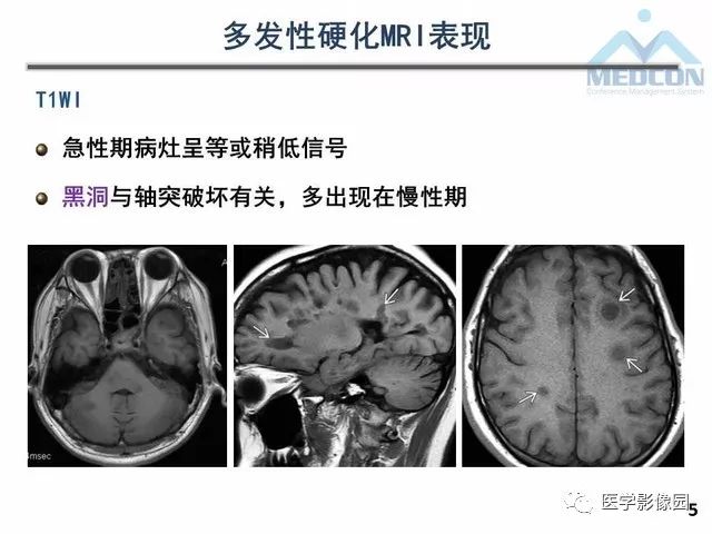 【PPT】MR在MS诊断与鉴别诊断中的价值