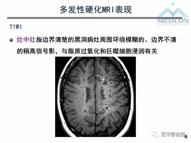 【PPT】MR在MS诊断与鉴别诊断中的价值