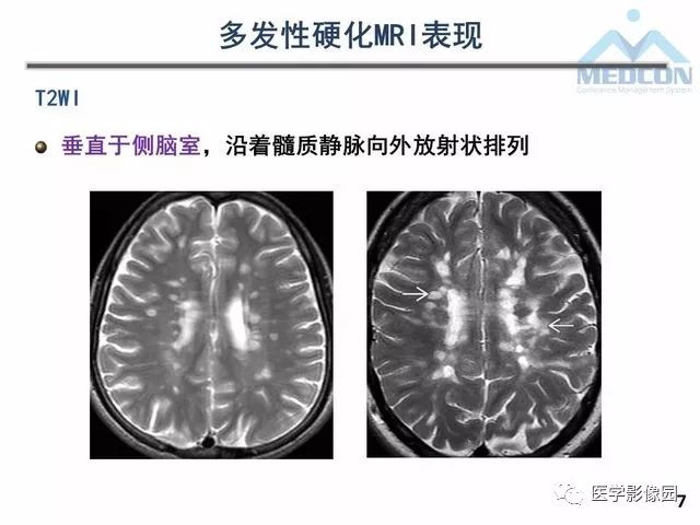 【PPT】MR在MS诊断与鉴别诊断中的价值
