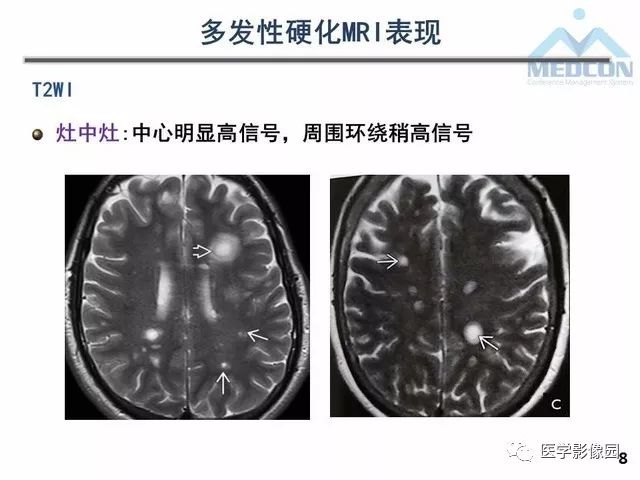 【PPT】MR在MS诊断与鉴别诊断中的价值