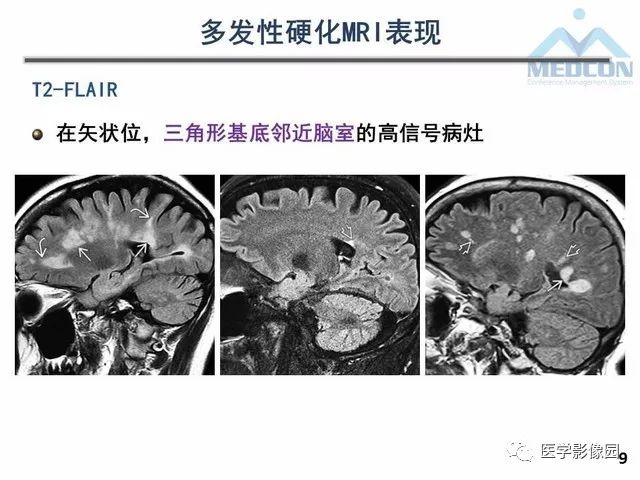 【PPT】MR在MS诊断与鉴别诊断中的价值