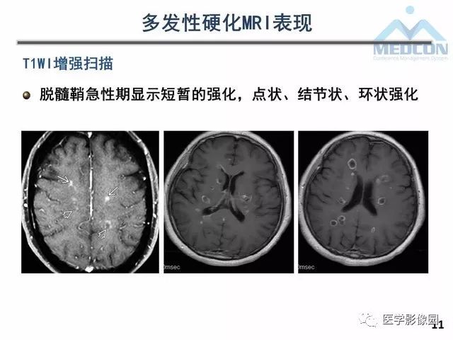 【PPT】MR在MS诊断与鉴别诊断中的价值