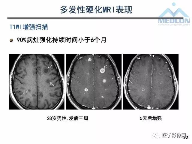 【PPT】MR在MS诊断与鉴别诊断中的价值