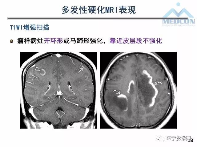 【PPT】MR在MS诊断与鉴别诊断中的价值