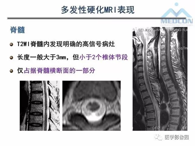 【PPT】MR在MS诊断与鉴别诊断中的价值