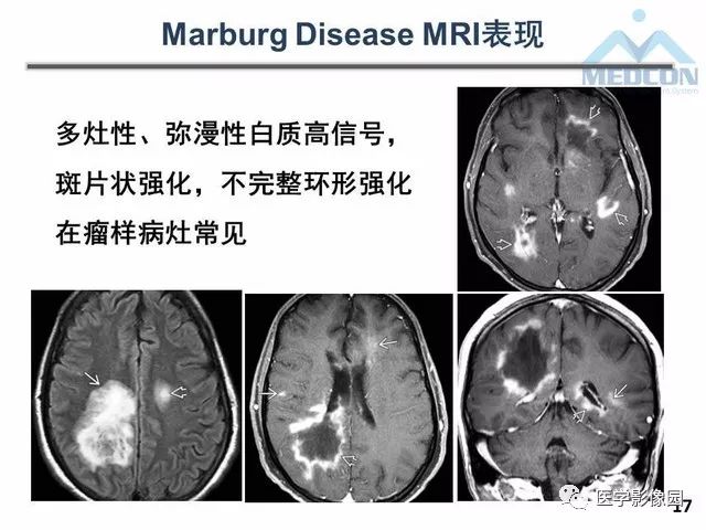 【PPT】MR在MS诊断与鉴别诊断中的价值
