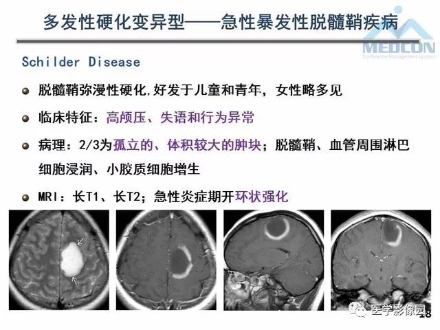 【PPT】MR在MS诊断与鉴别诊断中的价值