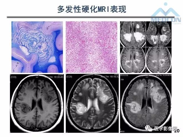 【PPT】MR在MS诊断与鉴别诊断中的价值