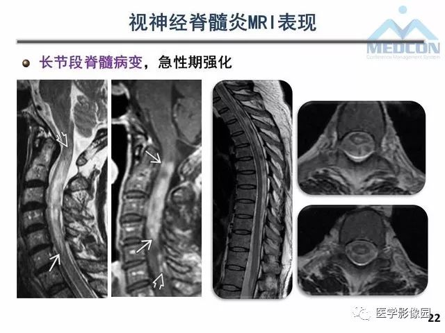 【PPT】MR在MS诊断与鉴别诊断中的价值
