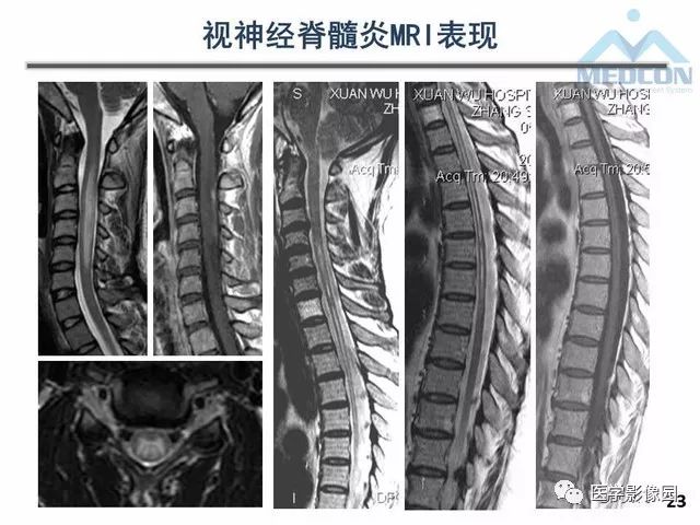 【PPT】MR在MS诊断与鉴别诊断中的价值