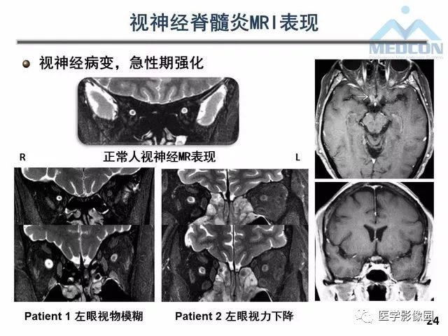 【PPT】MR在MS诊断与鉴别诊断中的价值