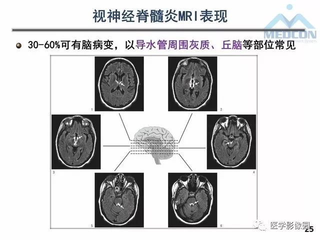 【PPT】MR在MS诊断与鉴别诊断中的价值