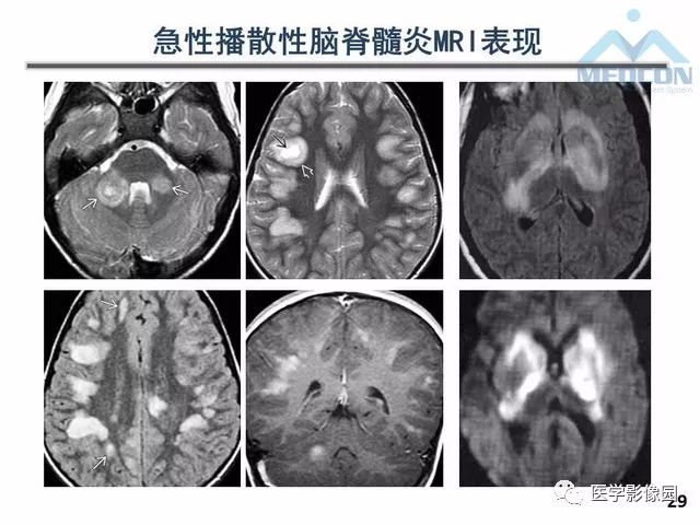 【PPT】MR在MS诊断与鉴别诊断中的价值