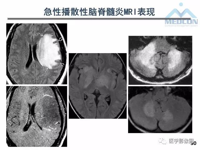 【PPT】MR在MS诊断与鉴别诊断中的价值