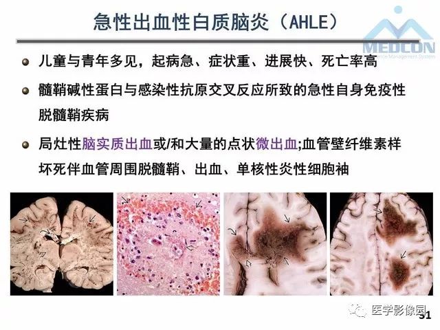 【PPT】MR在MS诊断与鉴别诊断中的价值